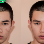 Accutane